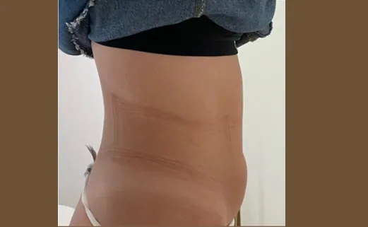Bauch nach der Körperbehandlung