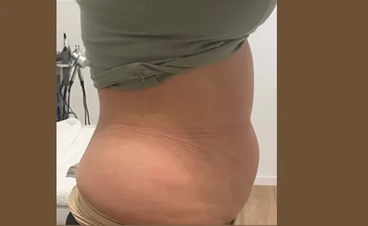 Bauch vor der Körperbehandlung