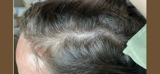 Kopfhaut vor MesoHair