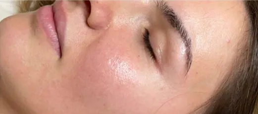 Haut nach dem Microneedling