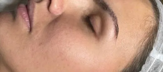 Haut vor dem Microneedling